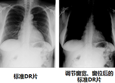 影響DR圖像質(zhì)量的因素有哪些方面