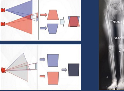 拍攝全脊柱X光片 長骨拼接技術和一板成像的區別