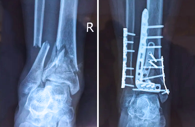【醫(yī)療科普】：關節(jié)內(nèi)的骨折